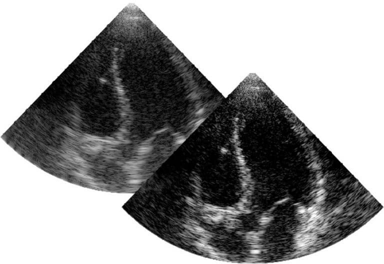Ultrasound B-Mode Image Reconstruction 